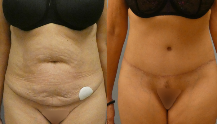 How Abdominoplasty in Raleigh, NC Helps Achieve a Firm and Toned Abdomen